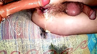 massive prostate  shinny up